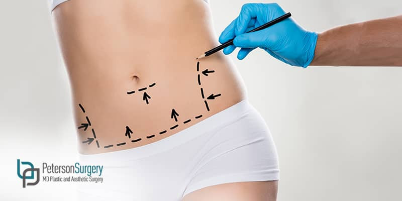Peterson MD - Blog - Things You Should Consider Before Having A Tummy Tuck
